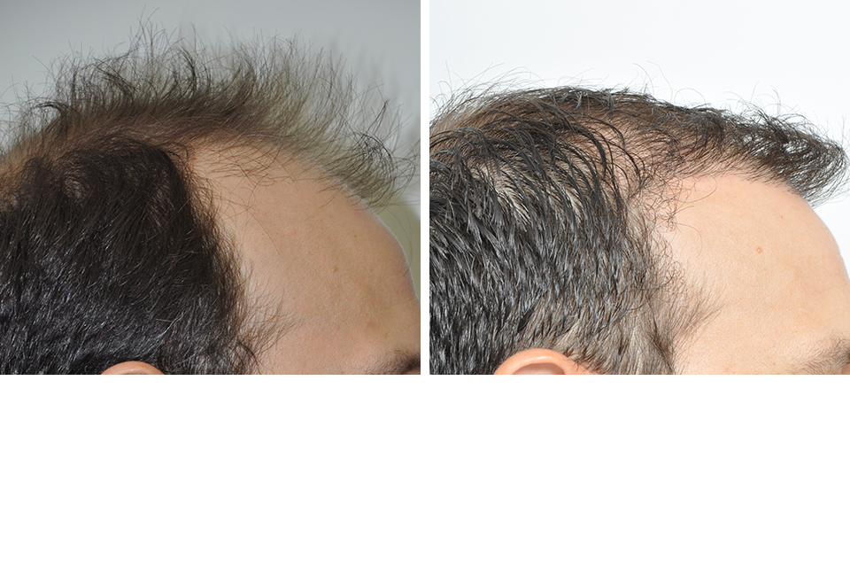 Hair Restoration case #3476