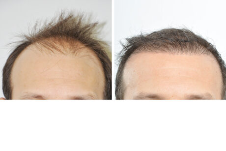 Hair Restoration case #3473
