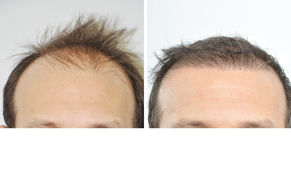 Hair Restoration case #3473