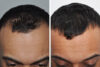 Hair Restoration case #3485 slider thumbnail