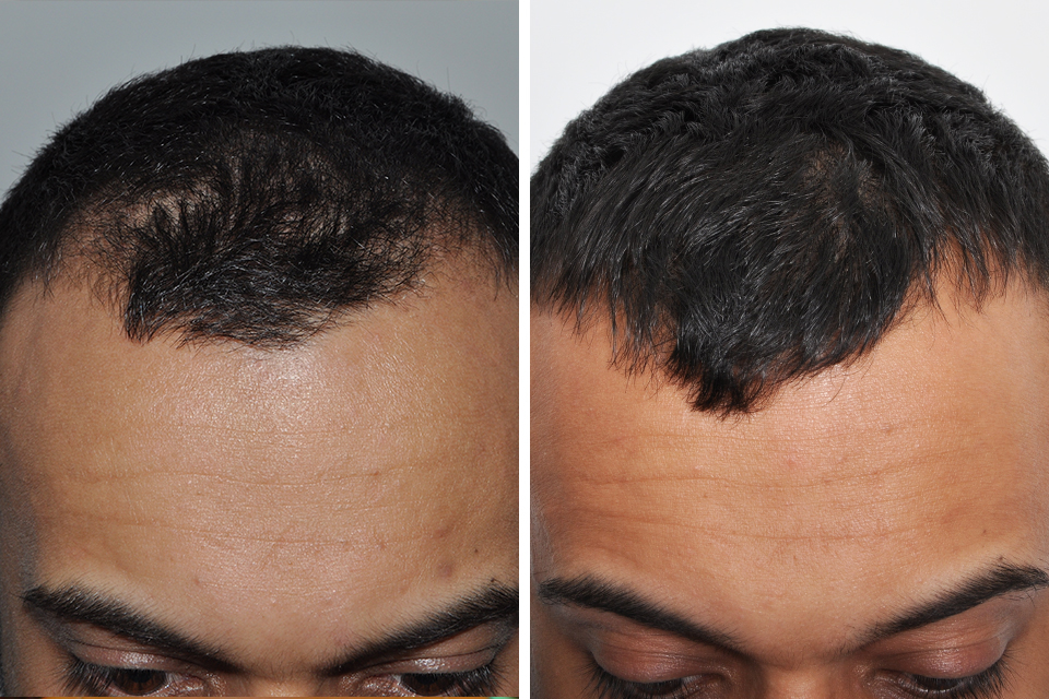 Hair Restoration case #3485