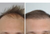 Hair Restoration case #3473 slider thumbnail