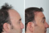 Hair Restoration case #3460 slider thumbnail