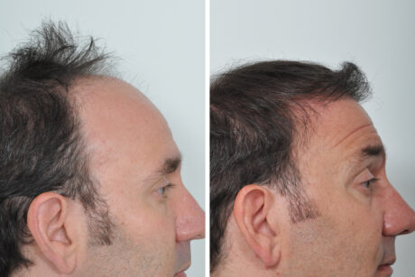 Hair Restoration case #3460