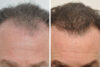 Hair Restoration case #3464 slider thumbnail