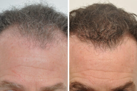 Hair Restoration case #3464