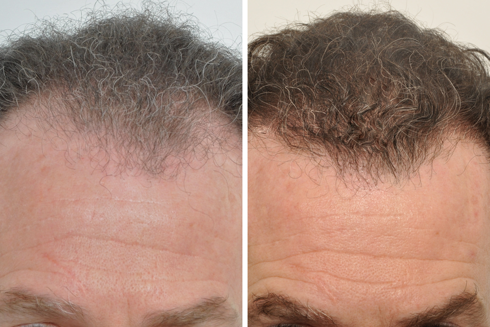 Hair Restoration case #3464