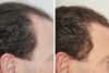 Hair Restoration case #3464 slider thumbnail