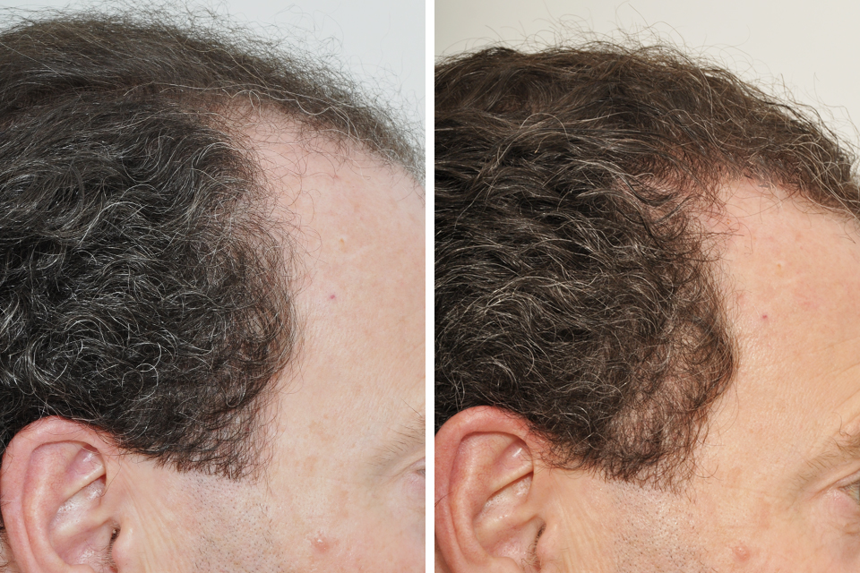 Hair Restoration case #3464