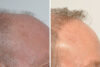 Hair Restoration case #3468 slider thumbnail