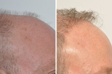 Hair Restoration case #3468