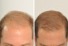 Hair Restoration case #3456 slider thumbnail