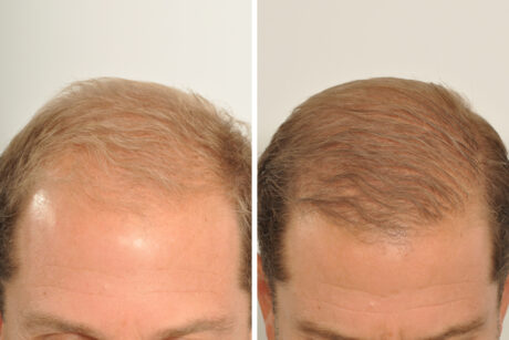 Hair Restoration case #3456