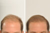 Hair Restoration case #3456 slider thumbnail