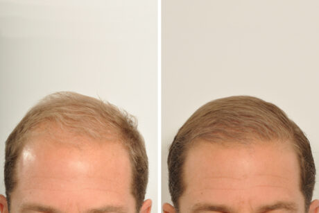 Hair Restoration case #3456