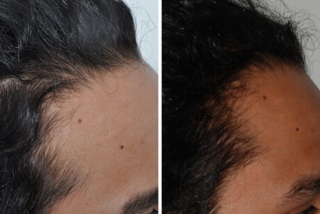 Hair Restoration case #3489