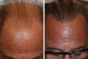 Hair Restoration case #3495 slider thumbnail