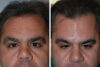 Hair Restoration case #3483 slider thumbnail