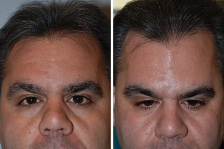 Hair Restoration case #3483