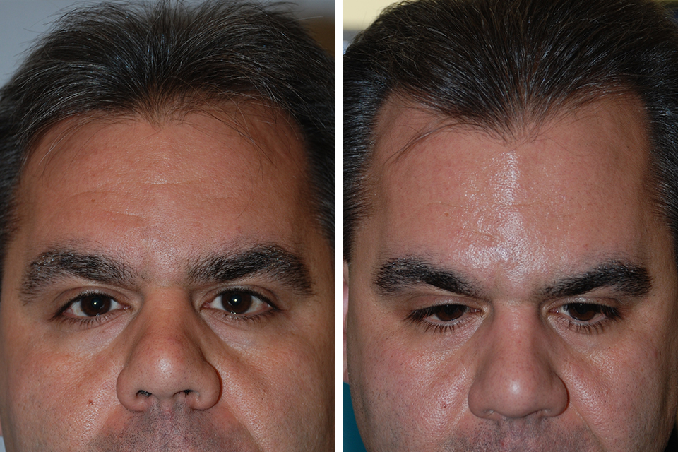 Hair Restoration case #3483