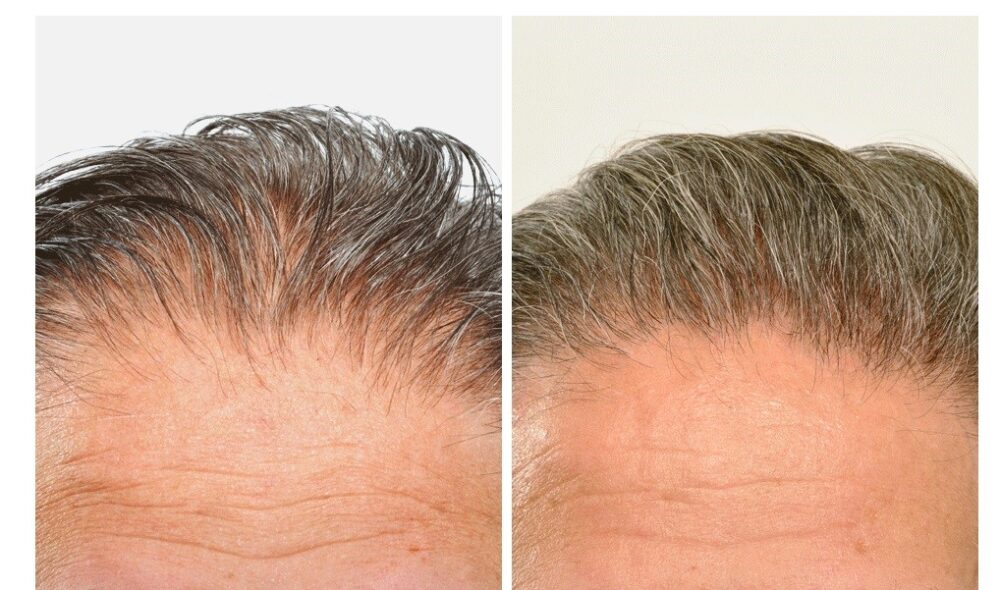 Hair Restoration case #3454