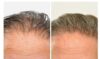 Hair Restoration case #3454 slider thumbnail
