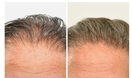 Hair Restoration case #3454
