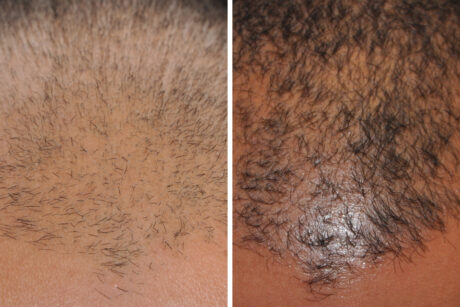 Hair Restoration case #3491