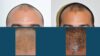 Hair Restoration case #3493 slider thumbnail