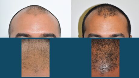 Hair Restoration case #3493