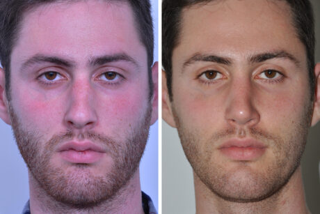 Rhinoplasty case #3526
