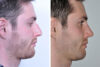 Rhinoplasty case #3526 slider thumbnail
