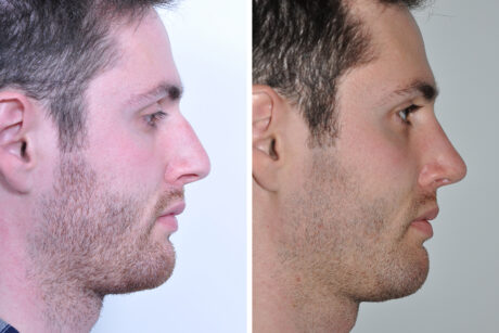 Rhinoplasty case #3526