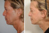 Rhinoplasty case #3524 slider thumbnail