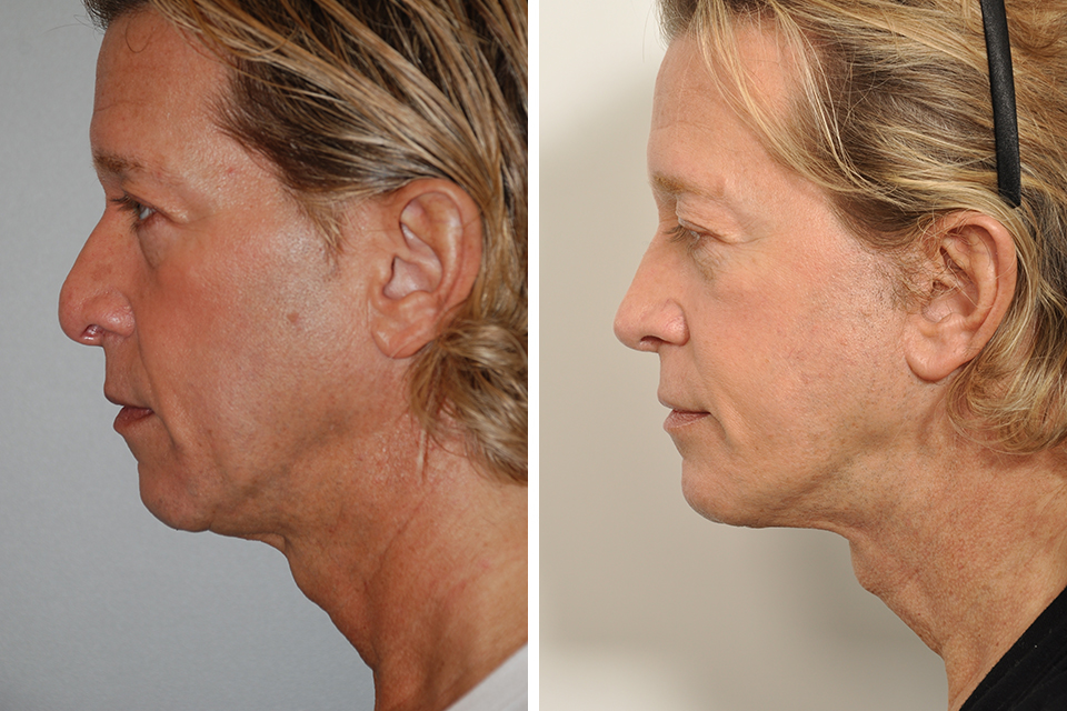 Rhinoplasty case #3524