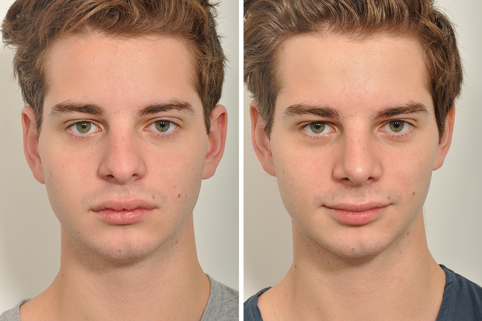 rhinoplasty-men-Rhinoplasty-154