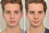 Rhinoplasty case #3509 slider thumbnail