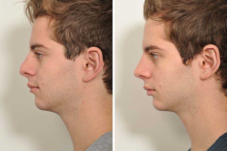 Rhinoplasty case #3509
