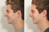 Rhinoplasty case #3509 slider thumbnail