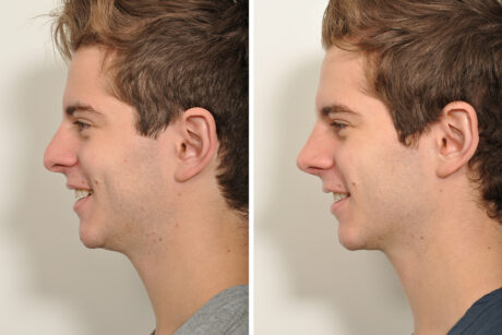 Rhinoplasty case #3509