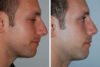 Rhinoplasty case #3531 slider thumbnail