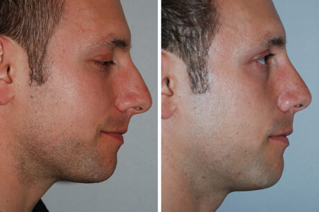 Rhinoplasty case #3531