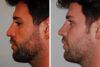 Rhinoplasty case #3533 slider thumbnail