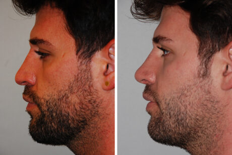 Rhinoplasty case #3533