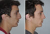 Rhinoplasty case #3535 slider thumbnail