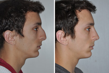 Rhinoplasty case #3535