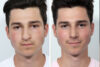 Rhinoplasty case #3497 slider thumbnail