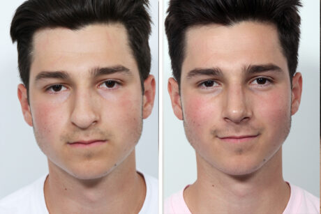 Rhinoplasty case #3497