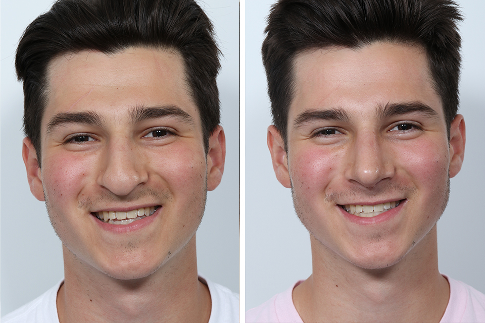 Rhinoplasty case #3497