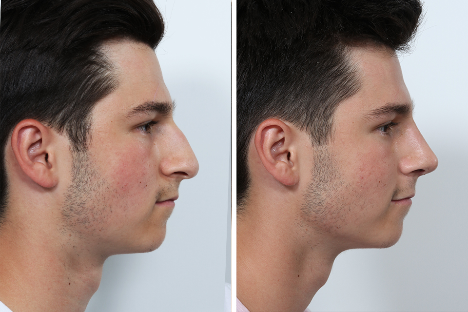 Rhinoplasty case #3497